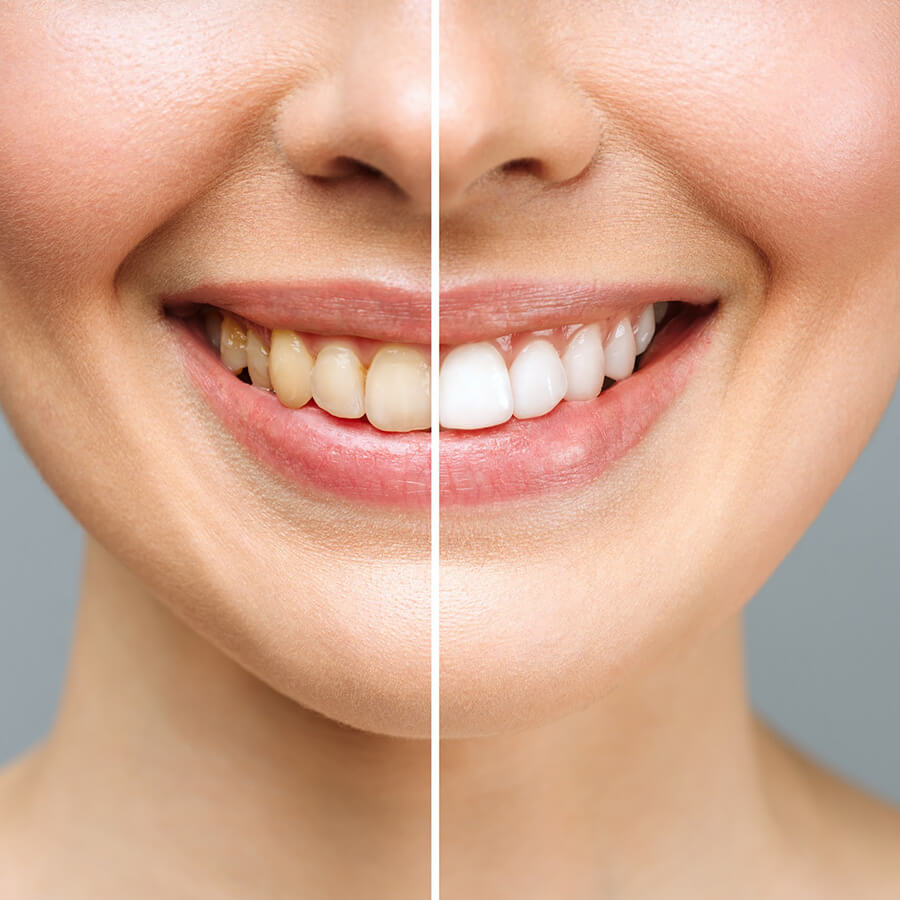 Smile Designing