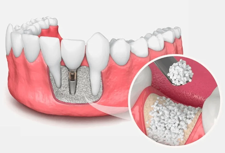 Bone Graft